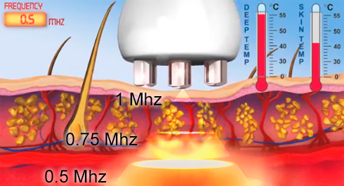 EQUIPO DE RADIOFRECUENCIA LIPOKONTUR DVTP